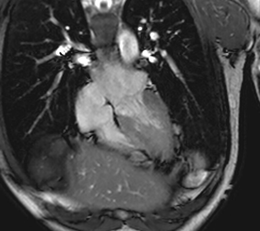 Arrhythmogenic right ventricular cardiomyopathy (Radiopaedia 39806-42237 D 119).jpg