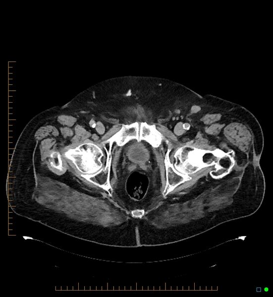 File:Artificial urethral sphincter (Radiopaedia 46937-51464 A 9).jpg