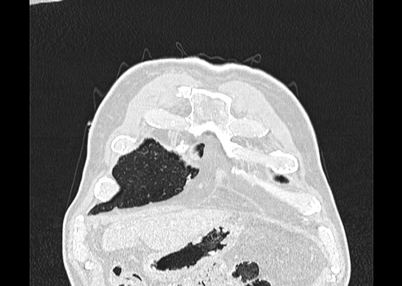 File:Asbestos pleural placques (Radiopaedia 57905-64872 Coronal lung window 14).jpg