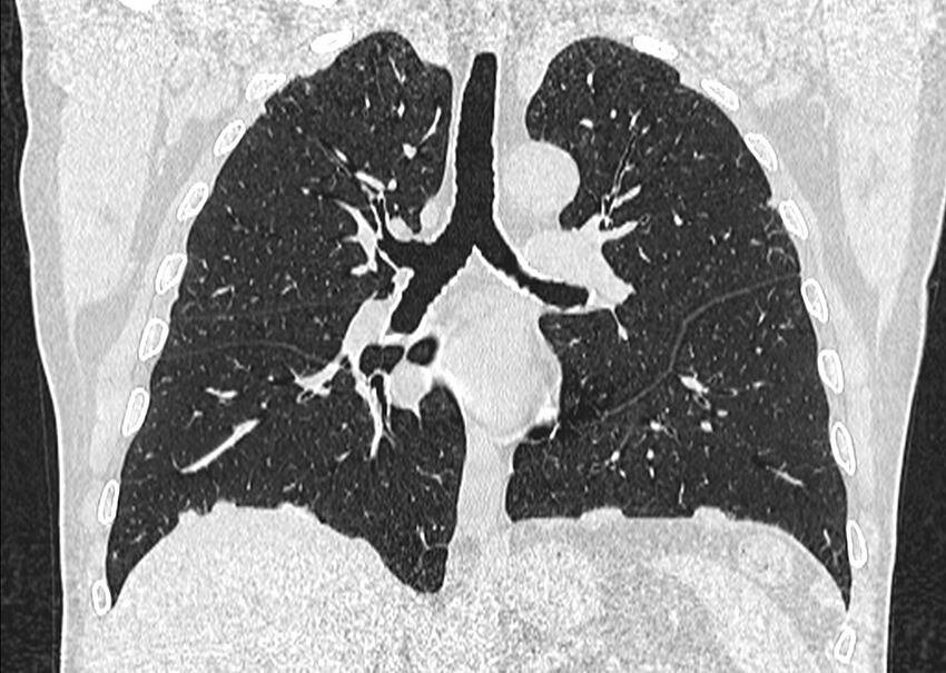 Asbestos pleural placques (Radiopaedia 57905-64872 Coronal lung window 157).jpg