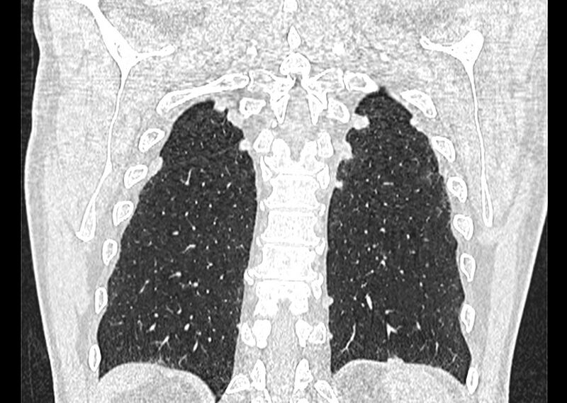 File:Asbestos pleural placques (Radiopaedia 57905-64872 Coronal lung window 243).jpg
