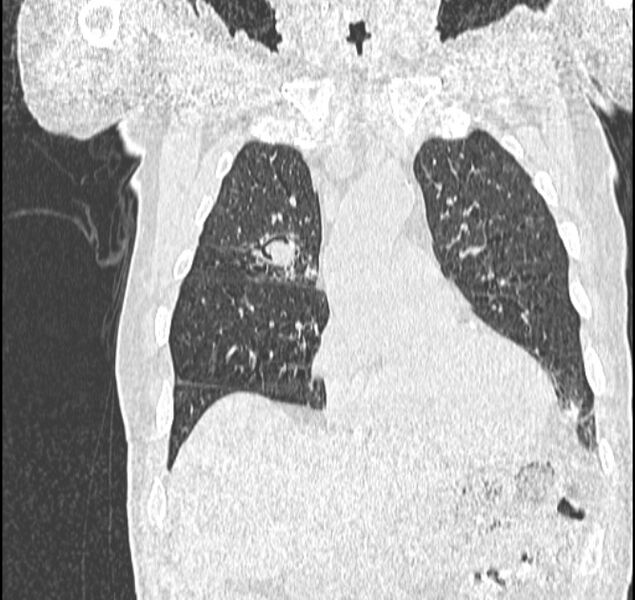 File:Aspergilloma (Radiopaedia 44592-48327 Coronal lung window 36).jpg