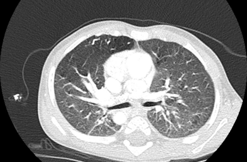 File:Asplenia syndrome (Radiopaedia 73083-83792 Axial lung window 27).jpg