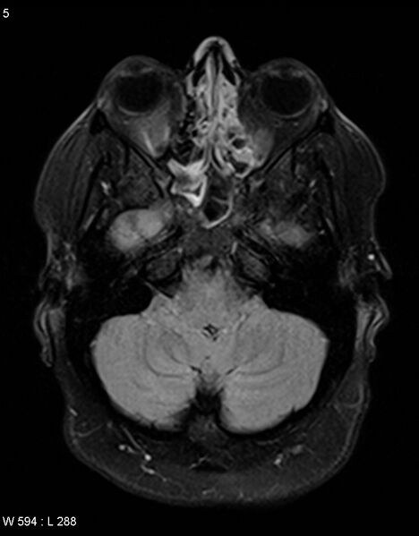 File:Astroblastoma (Radiopaedia 39792-42217 Axial FLAIR 4).jpg