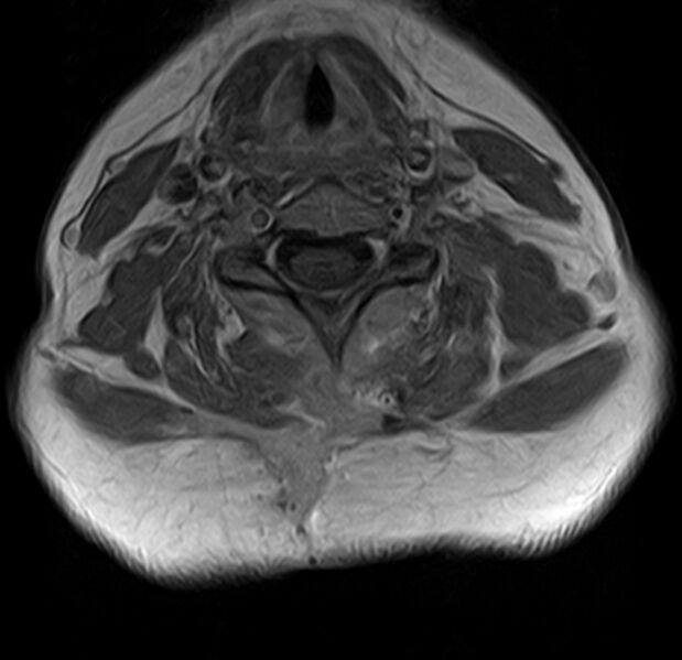 File:Astrocytoma - spinal cord (Radiopaedia 69769-79758 Axial T1 C+ 12).jpg
