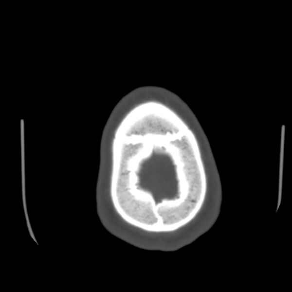File:Asymptomatic occipital spur (Radiopaedia 87753-104201 Axial bone window 203).jpg