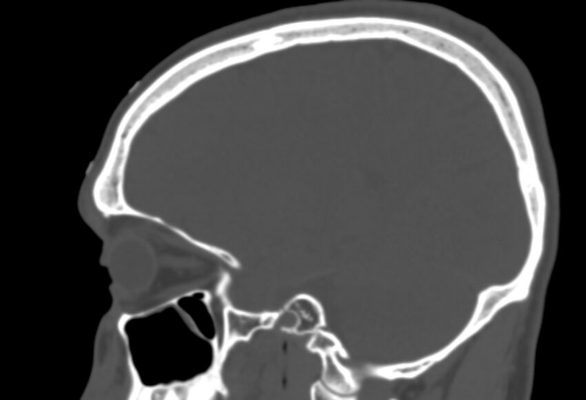 Asymptomatic occipital spur (Radiopaedia 87753-104201 Sagittal bone window 198).jpg