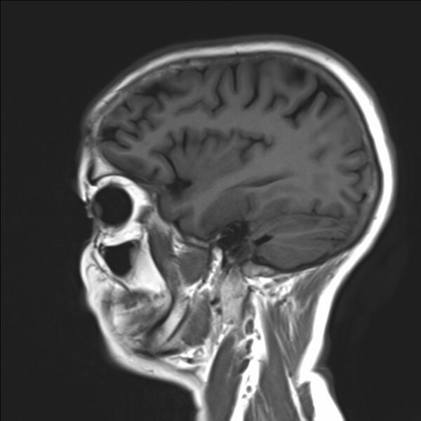 File:Atlanto-occipital assimilation with basilar invagination (Radiopaedia 70122-80157 Sagittal T1 18).jpg