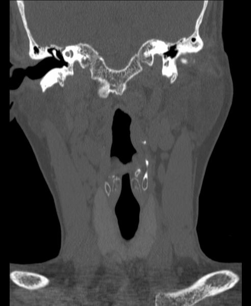 File:Atlanto-occipital assimilation with basilar invagination (Radiopaedia 70122-80188 Coronal bone window 35).jpg