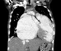 Atrial septal defect complicated by Eisenmenger syndrome (Radiopaedia 53707-59768 Coronal C+ CTPA 9).jpg