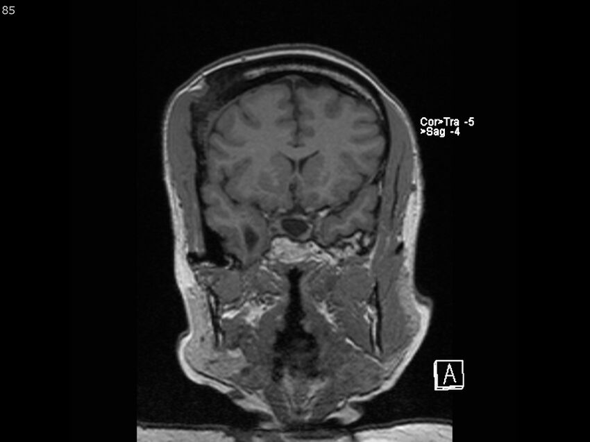 Atypical meningioma - intraosseous (Radiopaedia 64915-74572 Coronal T1 85).jpg