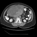 Atypical retroperitoneal lymphocoeles with large leiomyoma of uterus (Radiopaedia 32084-33024 A 20).jpg
