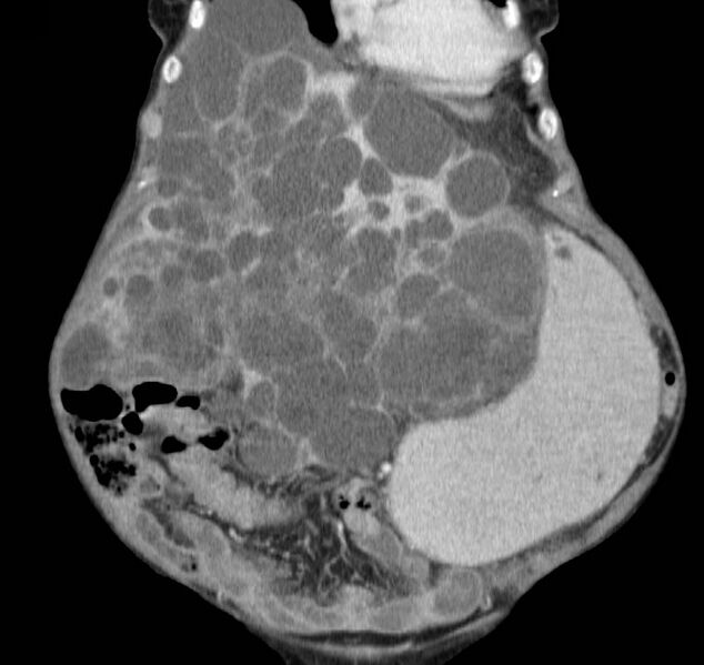File:Autosomal dominant polycystic kidney disease (Radiopaedia 16777-16490 B 10).jpg