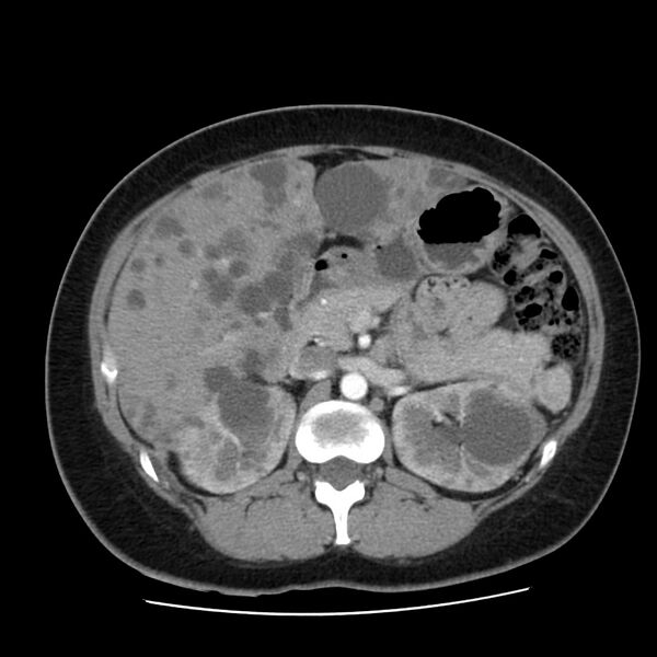 File:Autosomal dominant polycystic kidney disease (Radiopaedia 23061-23093 B 24).jpg