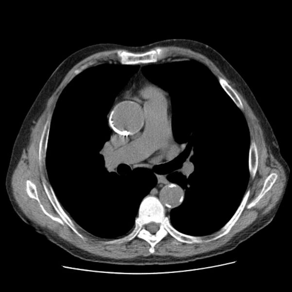 File:Autosomal dominant polycystic kidney disease (Radiopaedia 27851-28094 Axial non-contrast 26).jpg