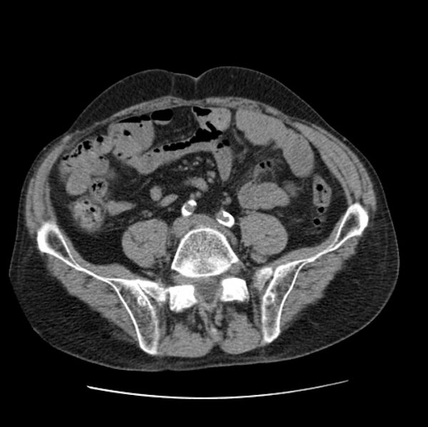 File:Autosomal dominant polycystic kidney disease (Radiopaedia 27851-28094 Axial non-contrast 89).jpg
