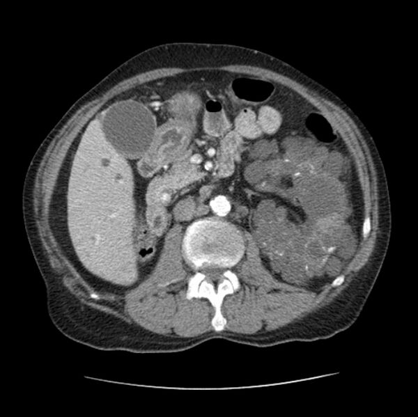 File:Autosomal dominant polycystic kidney disease (Radiopaedia 27851-28094 B 72).jpg