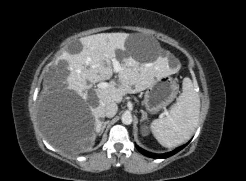 File:Autosomal dominant polycystic kidney disease (Radiopaedia 57124-64017 A 36).jpg