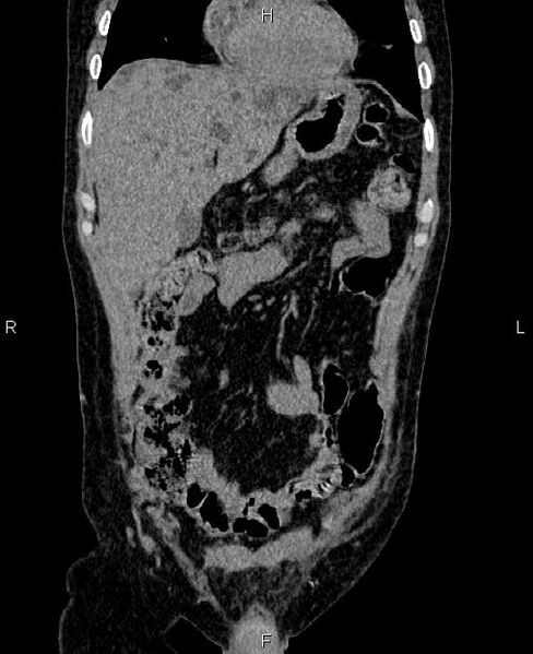 File:Autosomal dominant polycystic kidney disease (Radiopaedia 87830-104287 Coronal non-contrast 12).jpg