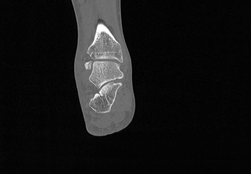 File:Avulsion fractures of talus and calcaneus (Radiopaedia 48277-53155 Coronal bone window 68).jpg