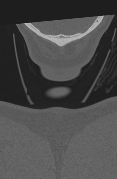 File:Axis peg fracture (type 3) and atlas lateral mass (type 4) fracture (Radiopaedia 37474-39324 Coronal bone window 78).png