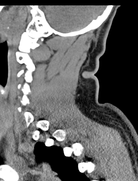 File:Axis peg fracture (type 3) and atlas lateral mass (type 4) fracture (Radiopaedia 37474-39324 D 22).png