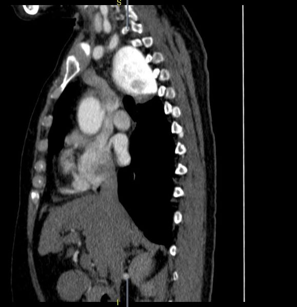 File:Azygos vein aneurysm (Radiopaedia 77824-90130 D 19).JPG