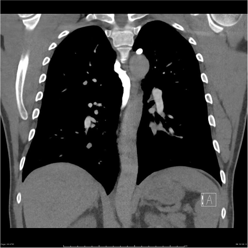 Azygos venous system anatomy (CT pulmonary angiography) (Radiopaedia 25928-26077 Coronal C+ CTPA 49).jpg