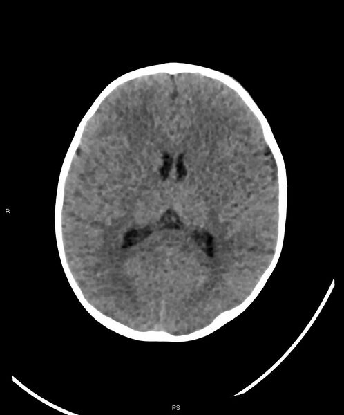 File:Basal ganglia and parenchymal ischemia (Radiopaedia 45818-50083 Axial non-contrast 21).jpg