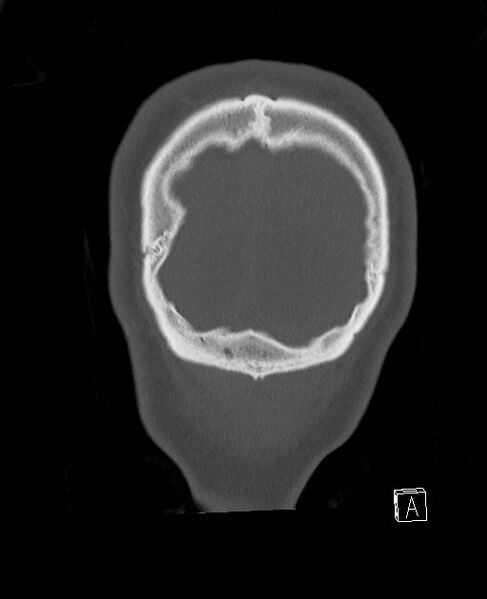 File:Base of skull fracture with bilateral Le Fort fractures (Radiopaedia 47094-51638 Coronal bone window 7).jpg