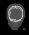 Base of skull fracture with bilateral Le Fort fractures (Radiopaedia 47094-51638 Coronal bone window 7).jpg