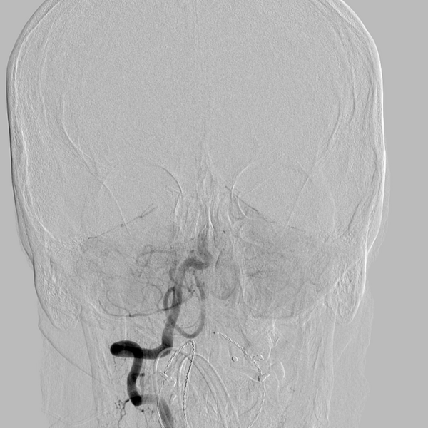 File:Basilar artery occlusion (Radiopaedia 33570-34668 RT VERT IC 18).png