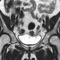 Bicornuate uterus (Radiopaedia 11104-11492 Coronal T2 3).jpg