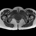 Bicornuate uterus (Radiopaedia 61974-70046 Axial T1 42).jpg