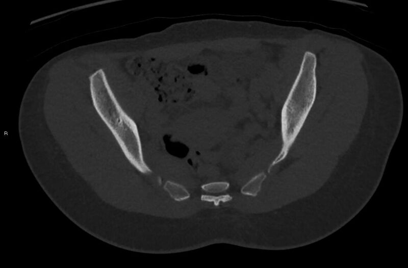 File:Bilateral mature cystic ovarian teratoma (Radiopaedia 88821-105592 Axial bone window 12).jpg