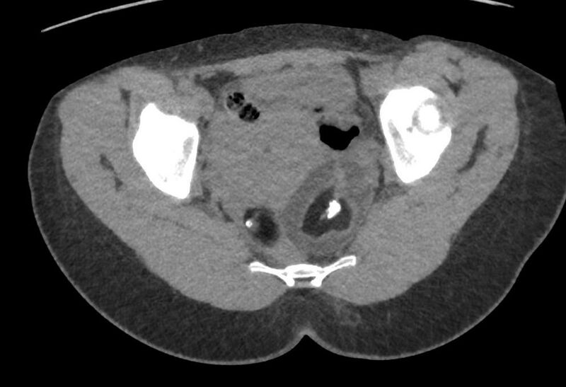 File:Bilateral mature cystic ovarian teratoma (Radiopaedia 88821-105592 Axial non-contrast 30).jpg