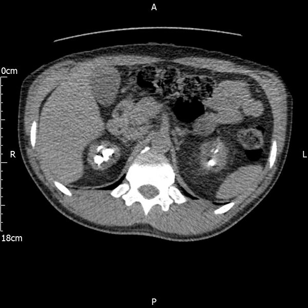File:Bilateral medullary nephrocalcinosis with ureteric calculi (Radiopaedia 71269-81569 Axial non-contrast 32).jpg
