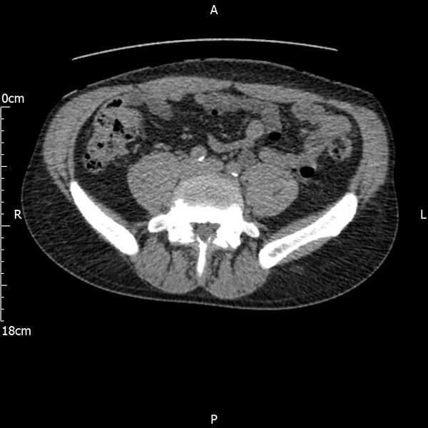 File:Bilateral medullary nephrocalcinosis with ureteric calculi (Radiopaedia 71269-81569 Axial non-contrast 84).jpg