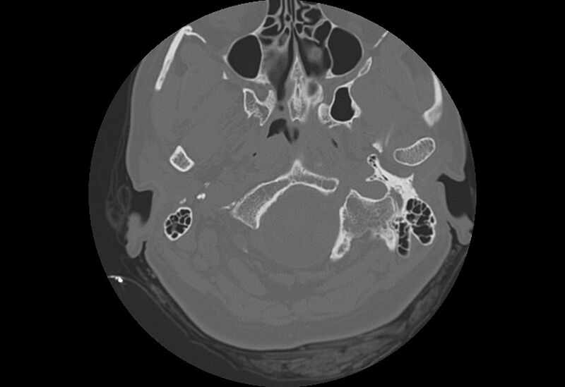 File:Bilateral otospongiosis (Radiopaedia 35447-36940 Axial bone window 2).jpg