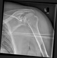 Bilateral posterior shoulder dislocation (Radiopaedia 54102-60281 Frontal 1).jpg