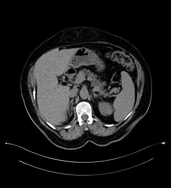 File:Bilateral sporadic synchronous clear cell renal cell carcinoma (Radiopaedia 85035-100575 Axial non-contrast 31).jpg