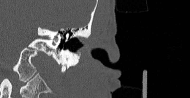 File:Bilateral temporal bone fractures (Radiopaedia 29482-29970 B 22).jpg