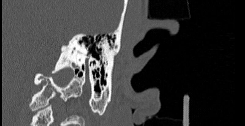File:Bilateral temporal bone fractures (Radiopaedia 29482-29970 Coronal 210).jpg