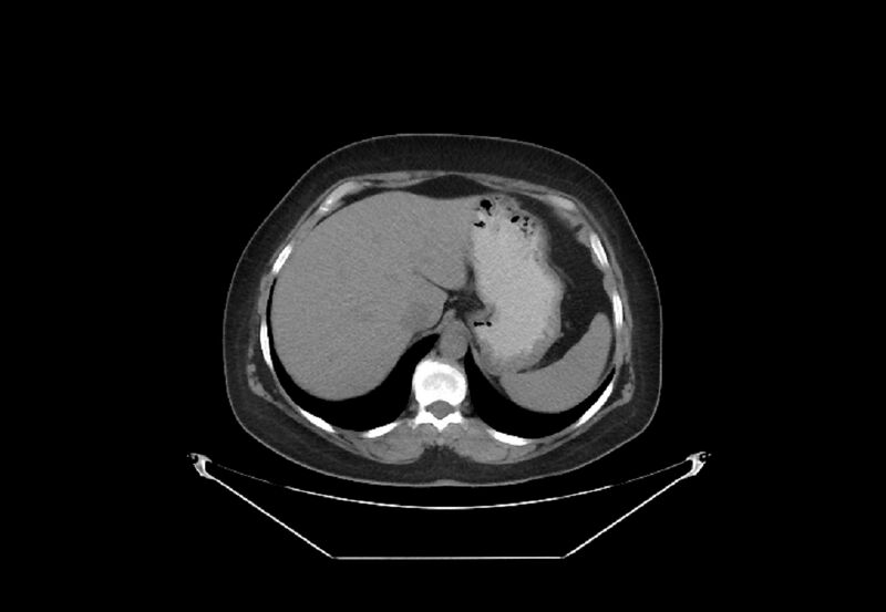 File:Bilateral urolithiasis with incidentally detected splenic artery aneurysm and left inferior vena cava (Radiopaedia 44467-48123 Axial non-contrast 5).jpg