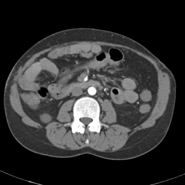File:Biliary necrosis - liver transplant (Radiopaedia 21876-21845 A 32).jpg