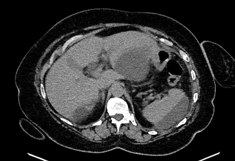 File:Biliary pancreatitis (Radiopaedia 72289-82823 Axial non-contrast 80).jpg