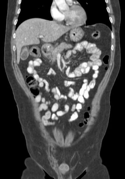 File:Bleeding duodenal ulcer and adenomyomatosis of gallbladder (Radiopaedia 61834-69861 B 58).jpg