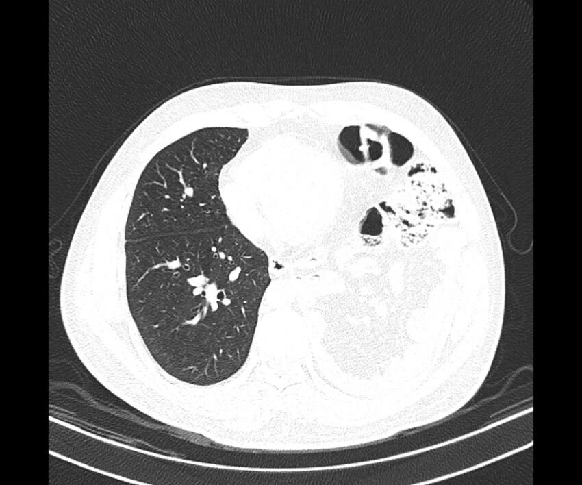Bochdalek hernia - adult presentation (Radiopaedia 74897-85925 Axial lung window 30).jpg