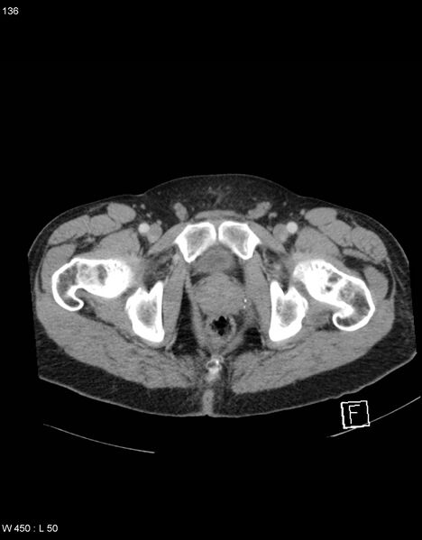 File:Boerhaave syndrome with tension pneumothorax (Radiopaedia 56794-63603 A 68).jpg