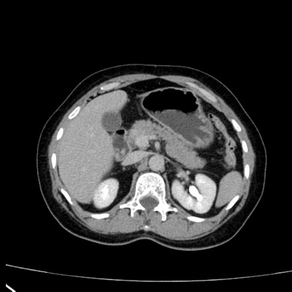 File:Bosniak renal cyst - type I (Radiopaedia 27479-27675 D 10).jpg